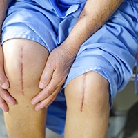 5 Common Mistakes Patients Make When Getting a Knee Replacement