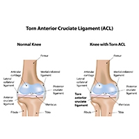 How Do You Know If You Tore Your ACL?
