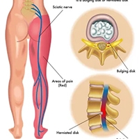 Sciatica