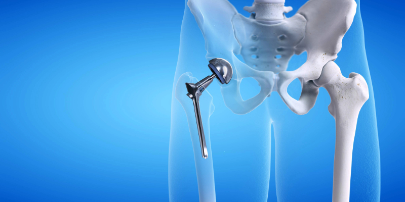 A virtual rendering that depicts a hip replacement implant, which includes two pieces, one that goes into the top of the thigh bone and the other that replaces the hip socket.